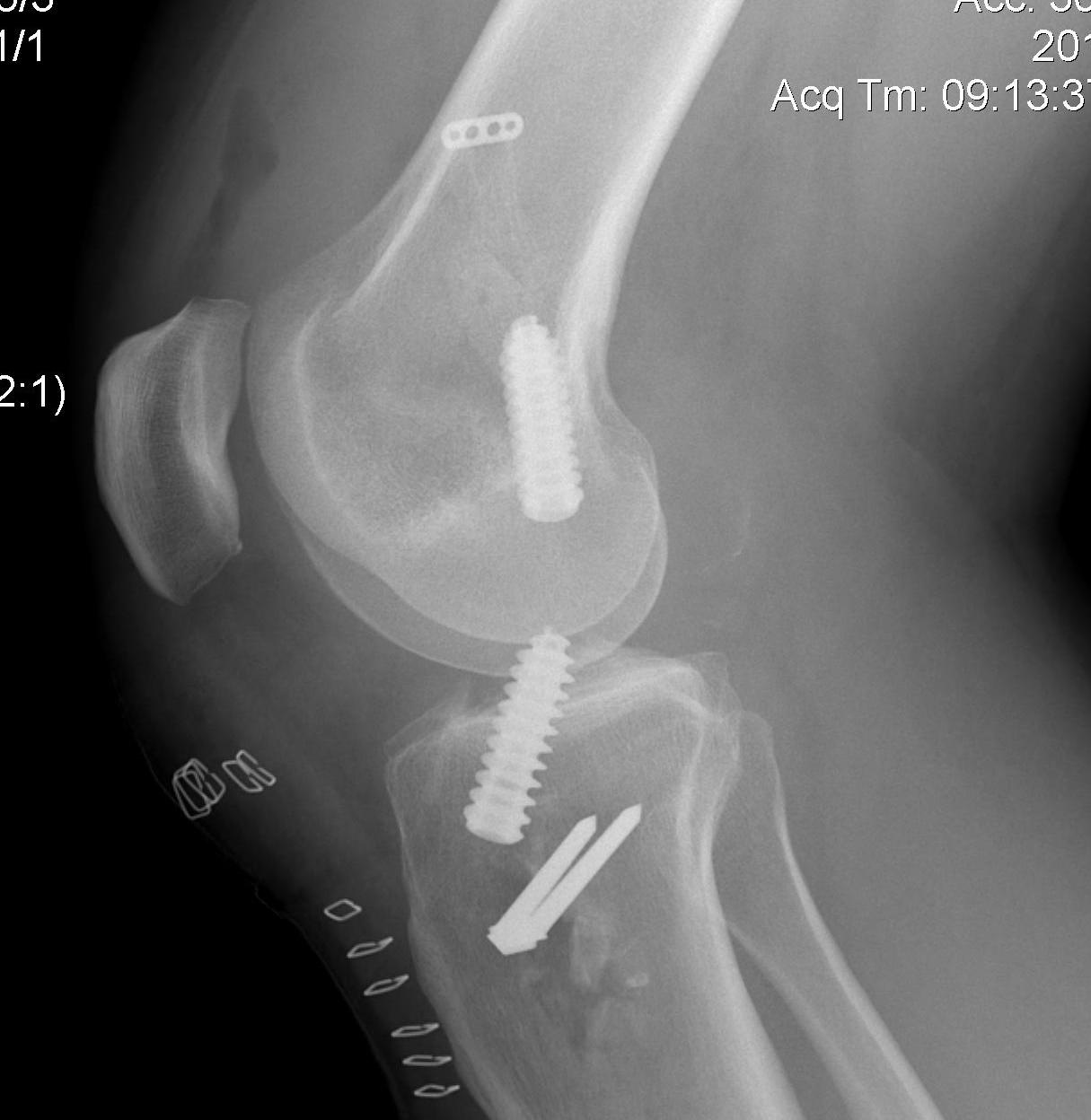 Revision ACL Post op Lateral